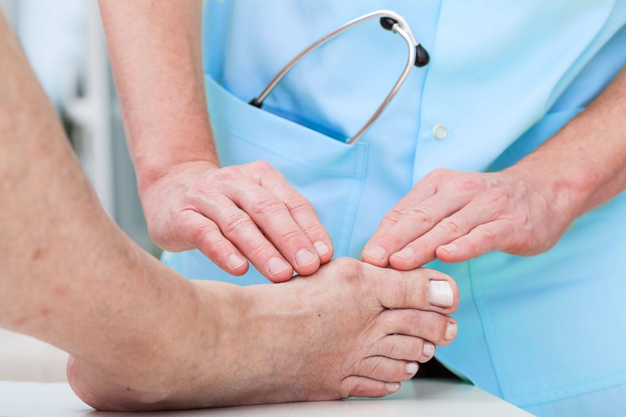 bunions