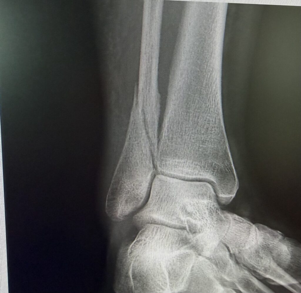 Lateral ankle fracture X-ray