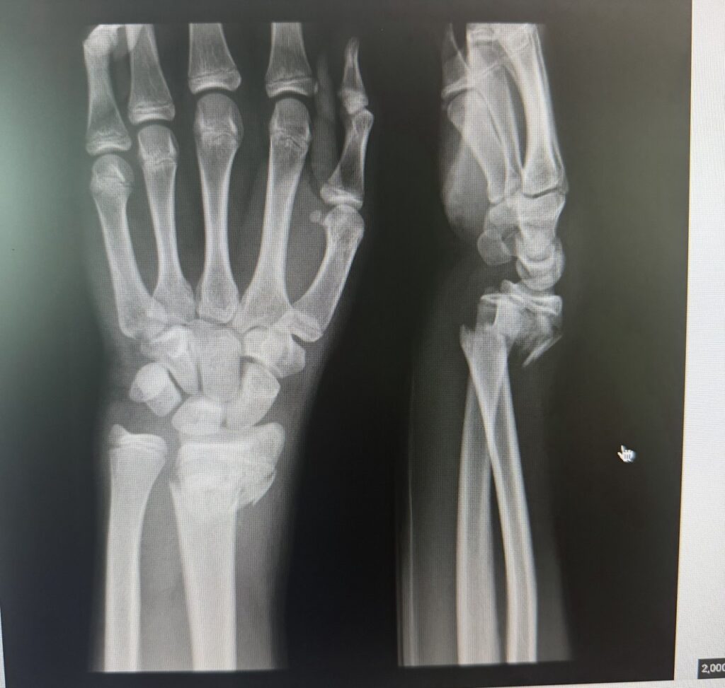 Distal radius wrist fracture X-ray