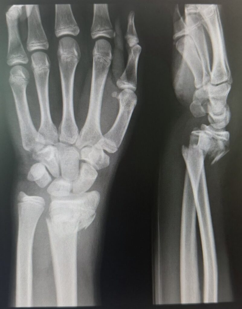 X-ray of a broken wrist showing a distal radius fracture, front and side views